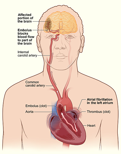 Illustration of a clot forming in the left atrium of the heart and traveling up the carotid artery to block blood flow to part of the brain