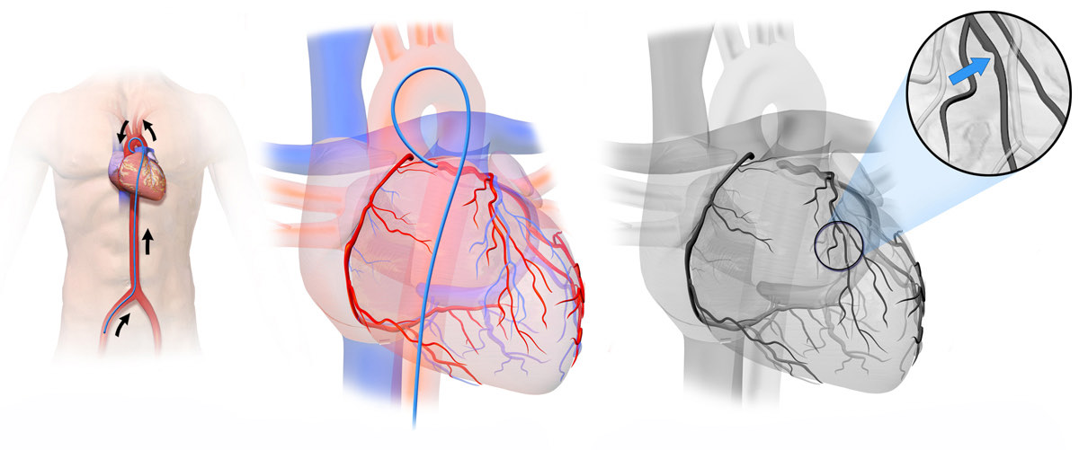 Illustration of a catheter threaded from the groin up to the heart, the coronary arteries, and an X-ray view with a narrowed artery circled