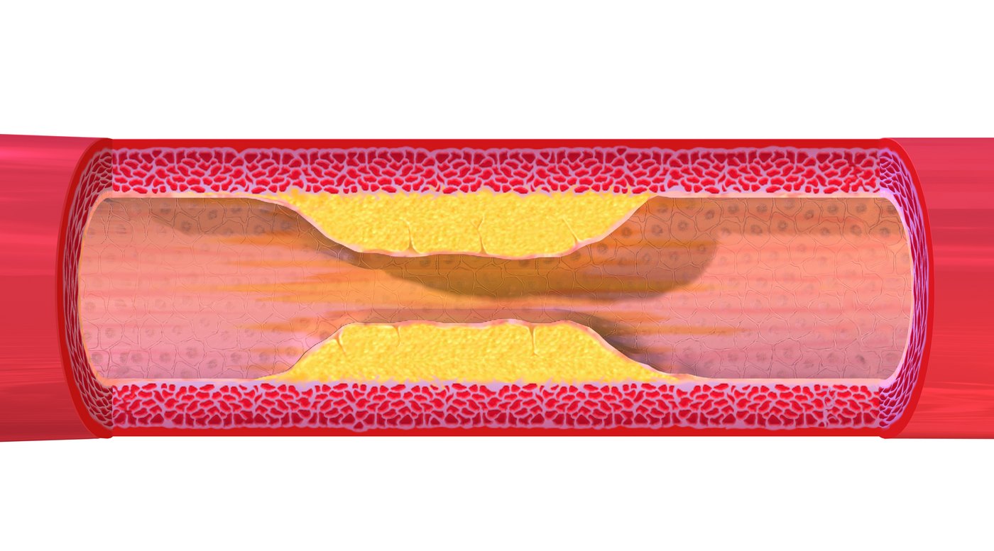 Cutaway illustration of an artery narrowed by yellow plaque along both walls